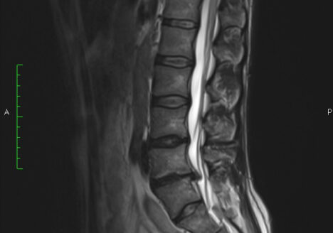 Lower Back Pain - herniated disc